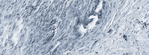 H&E-stained endometriotic lesion: two glands in fibrotic stroma