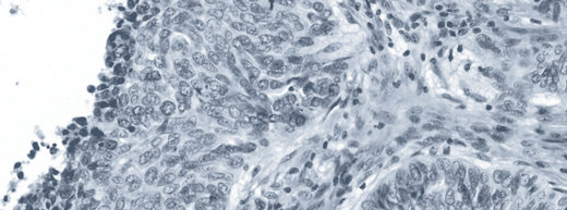 H&E-stained section of high-grade serous ovarian cancer